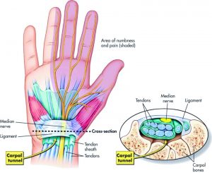 Sindrome del Tunnel Carpale: sintesi delle raccomandazioni